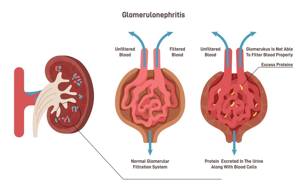 Glomerulonephritis