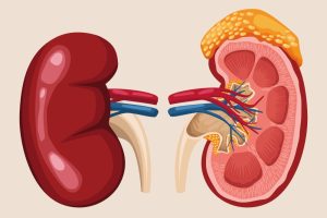 Kidney Transplant